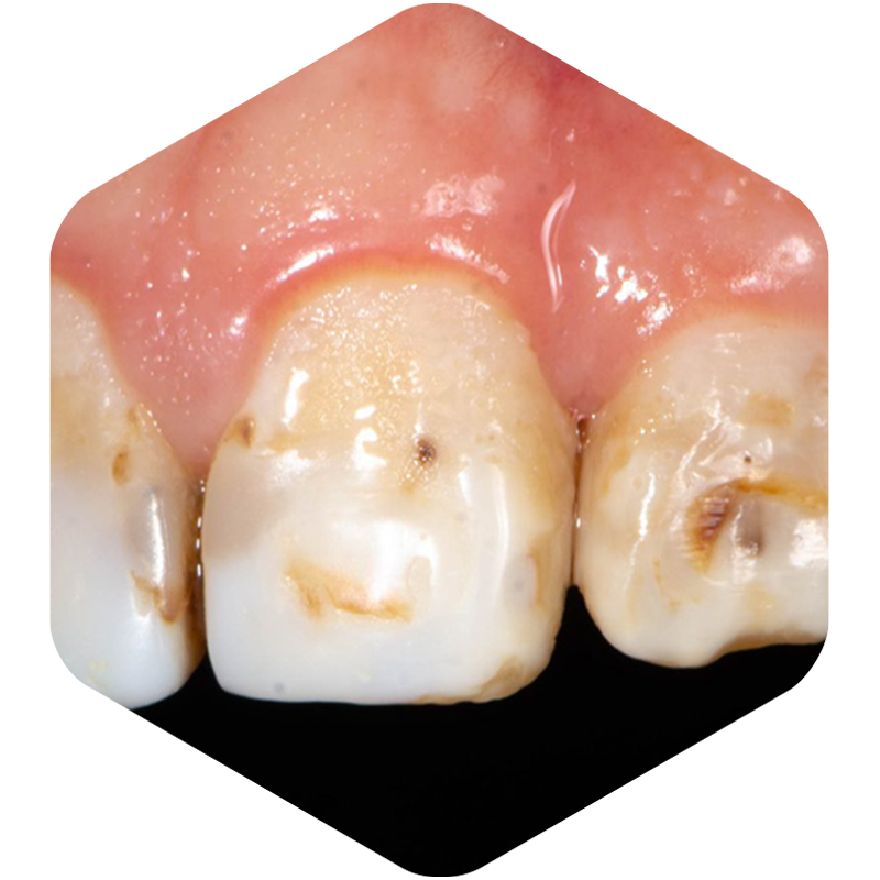 Teeth with significant discoloration